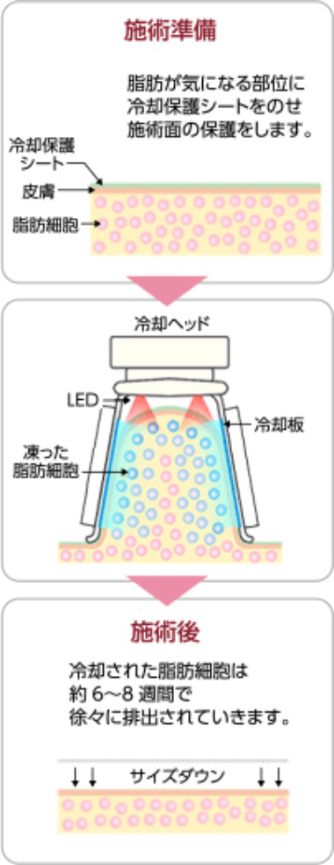 脂肪冷却痩身の特徴