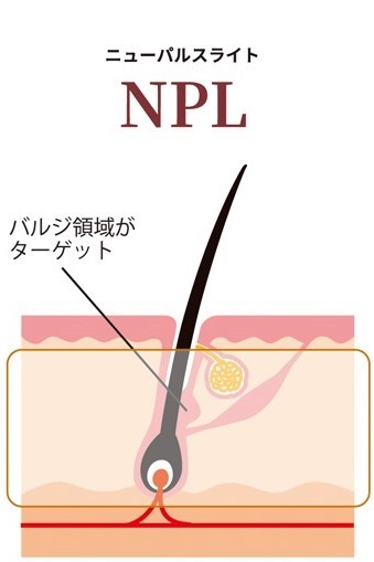 ラヴィールのSHR脱毛、LIGHENCE